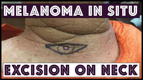 wide local excision melanoma in situ